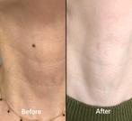 Élimination des imperfections cutanées : rapide, indolore et, Enlèvement ou Envoi