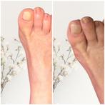 Pédicure medicale, Enlèvement