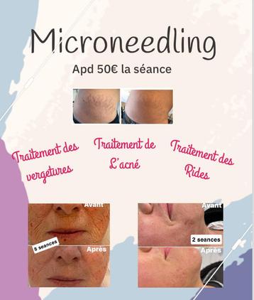 Microneedling, Enlèvement ou Envoi