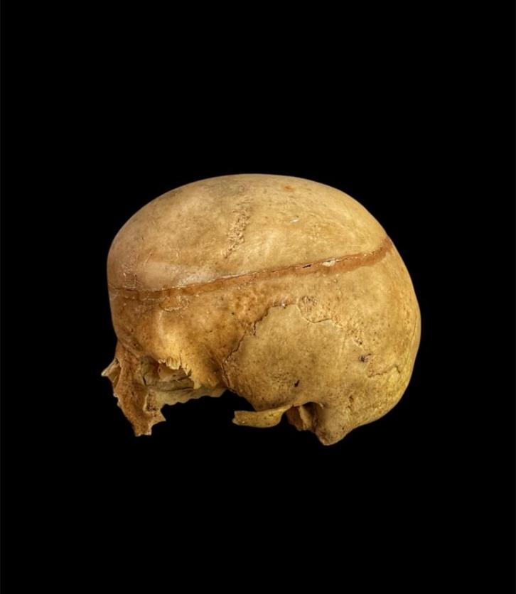 Scaphocephale schedel mens, Diversen, Overige Diversen, Gebruikt, Ophalen of Verzenden