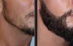 Minoxidil 5%, Ophalen, Nieuw