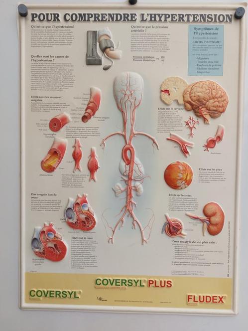 Affiche plastifiée sur l'hypertension artérielle, Verzamelen, Posters, Gebruikt, Ophalen