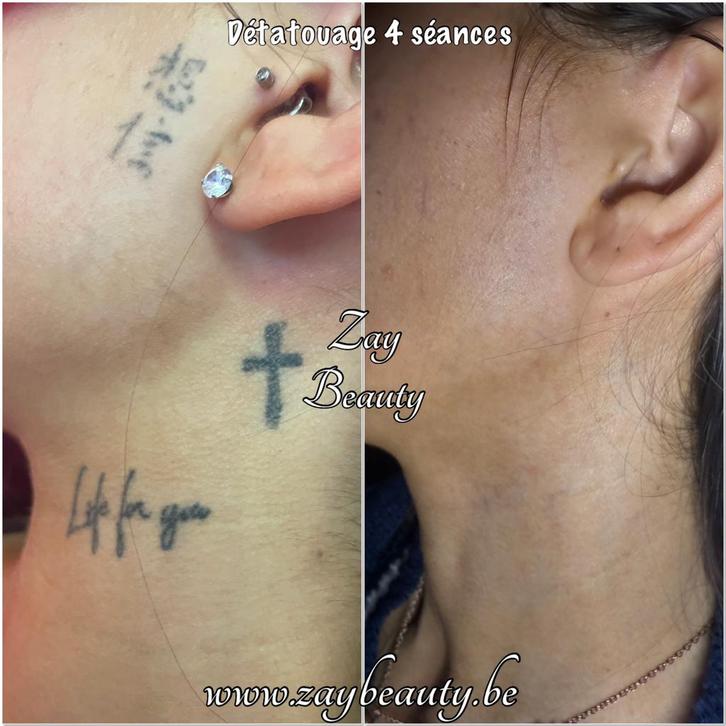 Détatouage au laser tattoo maquillage permanent Microblading, Handtassen en Accessoires, Uiterlijk | Gezichtsverzorging, Zo goed als nieuw