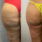 Anticellulitismassage, ontspannend, lymfedrainage, Kleding | Dames, Sportkleding, Ophalen of Verzenden