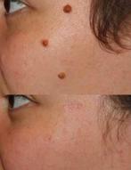 Élimination des imperfections cutanées : rapide, indolore, Enlèvement, Neuf